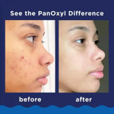 فوم شوینده ضدجوش پانوکسیل(PanOxil) اصل، ١۵۶ گرم